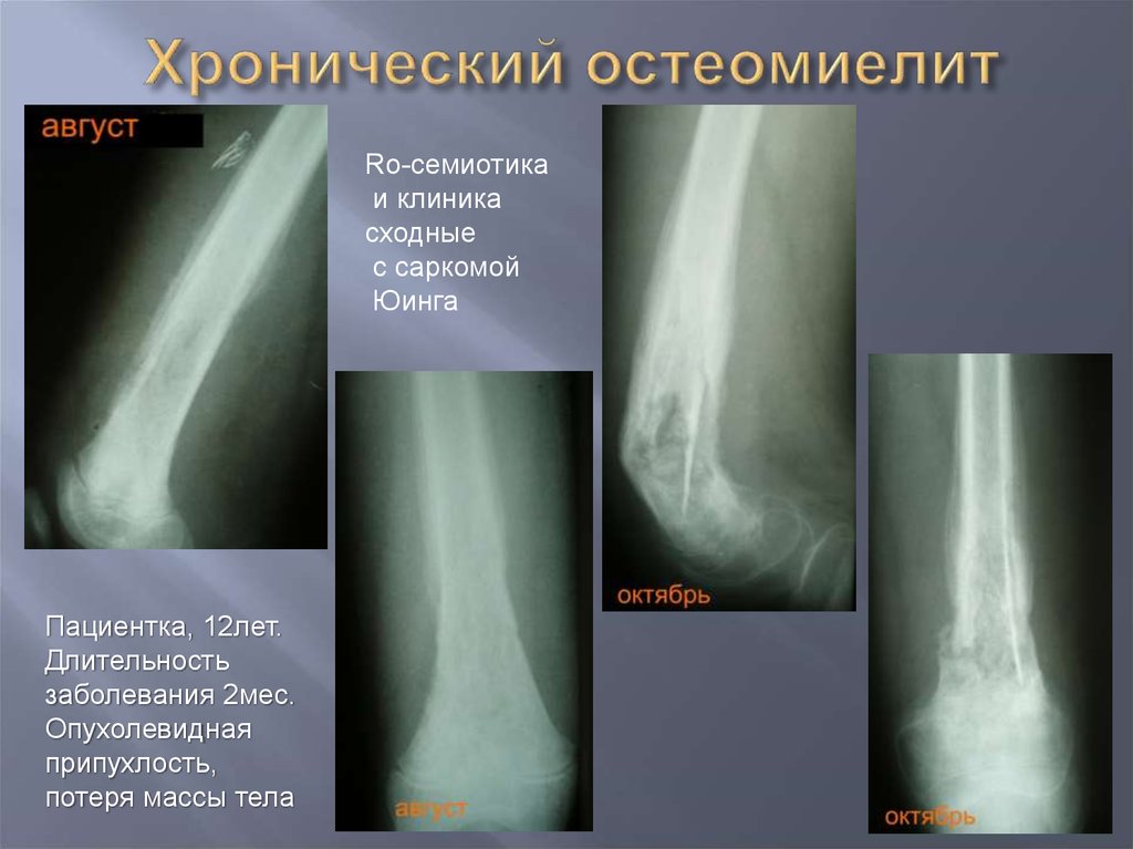 Остеомиелит у детей. Лимфогенный остеомиелит. Хронический остеогенный остеомиелит. Хронический остеомиелит синдромы. Хронический гематогенный остеомиелит рентген.