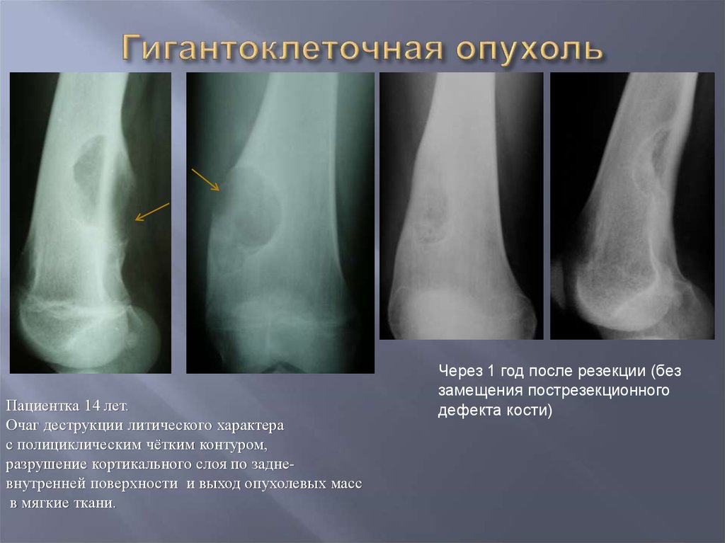 Рентгенологическая картина гигантоклеточной опухоли характеризуется разновидностями