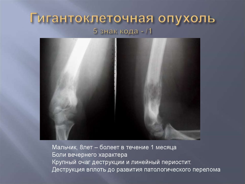 Для рентгенологической картины ячеистой формы гигантоклеточной опухоли характерно