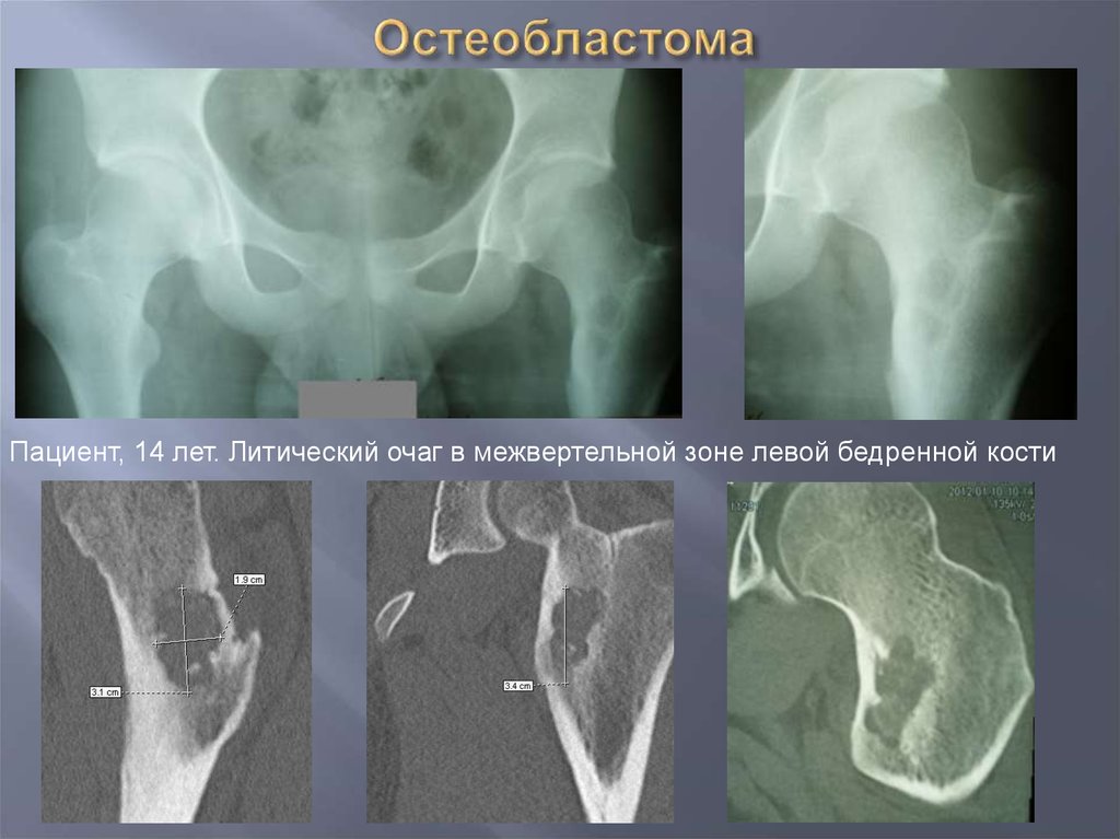 Очаговые изменения костей. Остеобластома тазобедренного сустава. Остеобластома бедренной кости кт. Остеобластома бедренной кости у детей. Остеобластома большеберцовой кости кт.