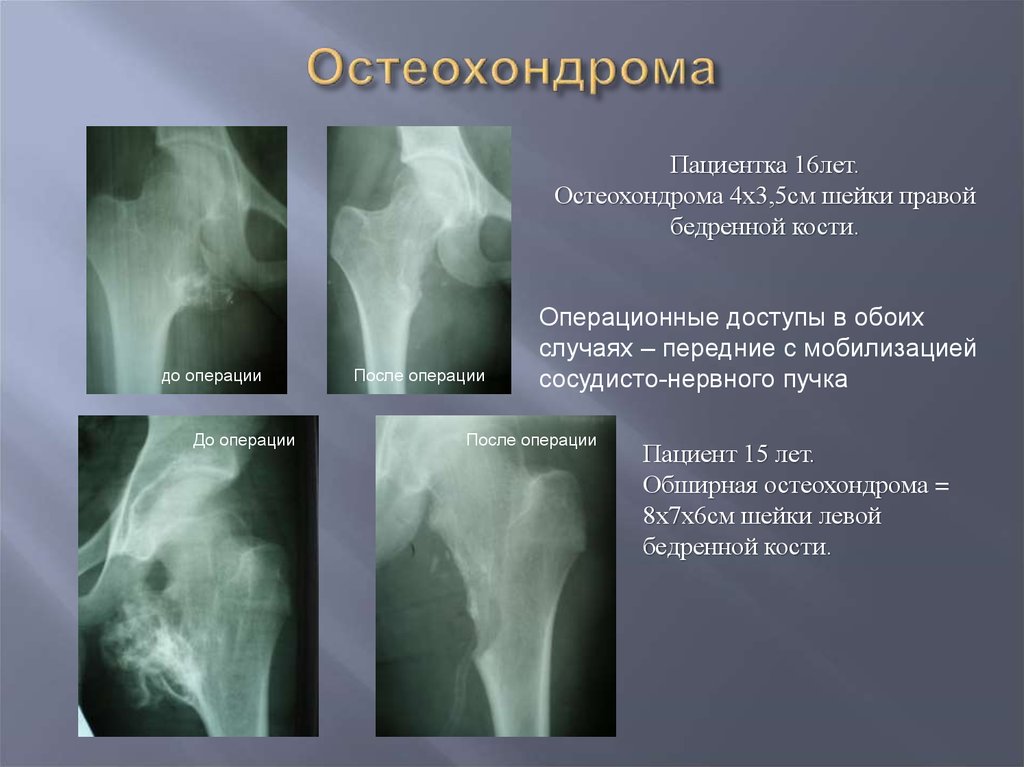 костно-хрящевой экзостоз, остеохондрома большеберцовой кости