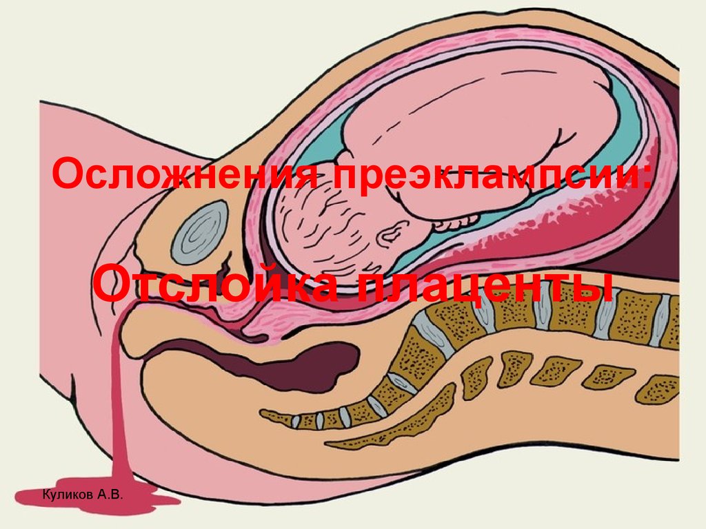 Отслойка плаценты фото выделений