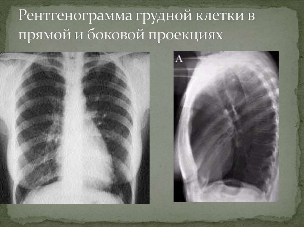 Флюорография в двух проекциях. Флюорография органов грудной клетки в прямой проекции. Рентген грудной клетки в прямой и боковой проекции. Рентген грудной клетки в прямой проекции норма. Рентген грудной клетки в 2 проекциях.