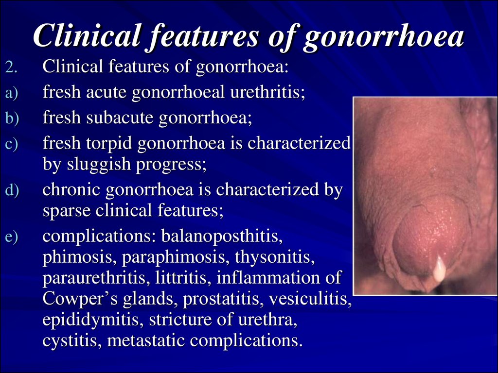 Gonorrhoea. Nongonorrhoeal urethritis - презентация онлайн1024 x 768
