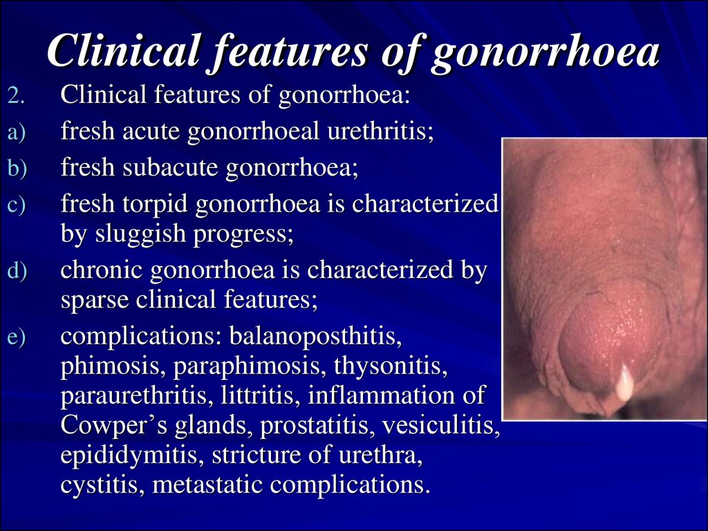 gonorrhoea-nongonorrhoeal-urethritis