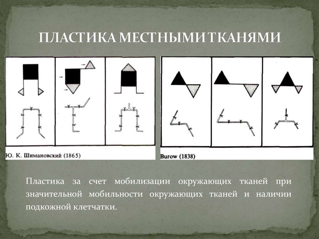 Пластика местными тканями презентация