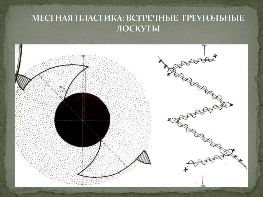 Пластика местными тканями. Лекция для студентов