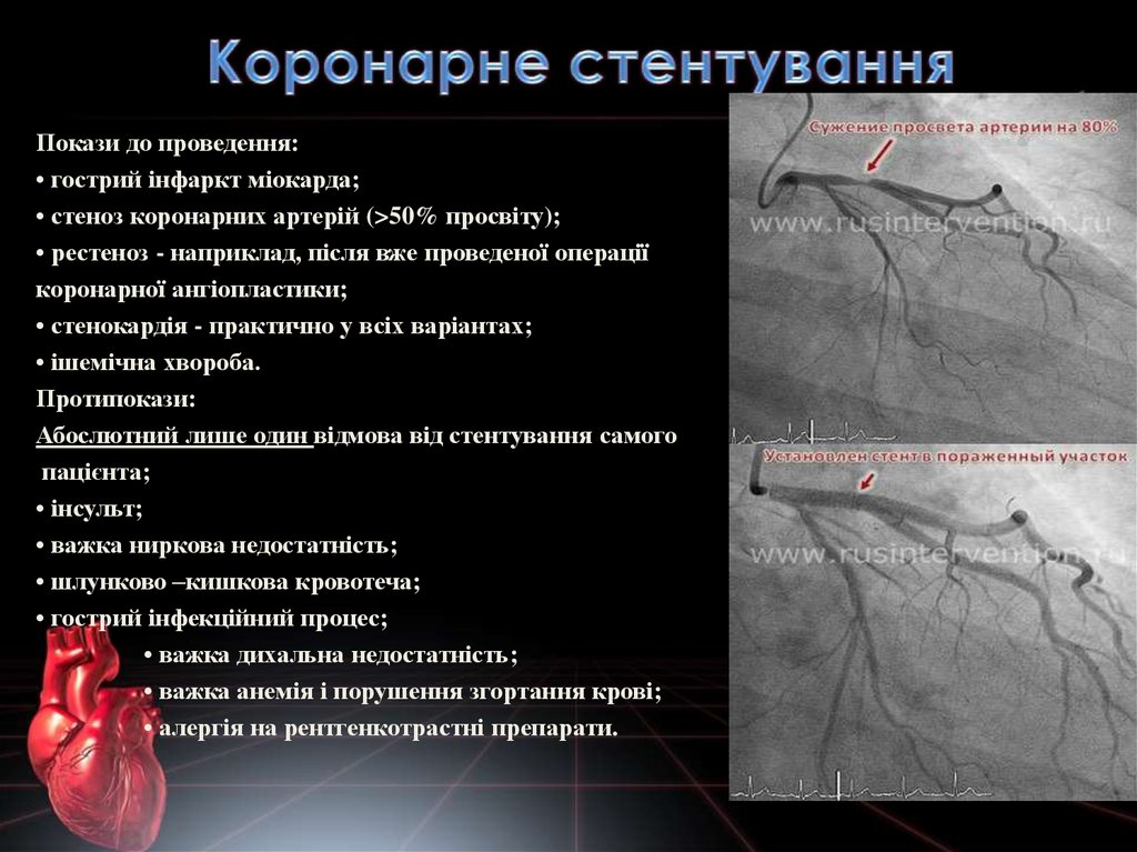Реферат: Особливості перебігу ішемічної хвороби серця у хворих після стентування коронарних артерій