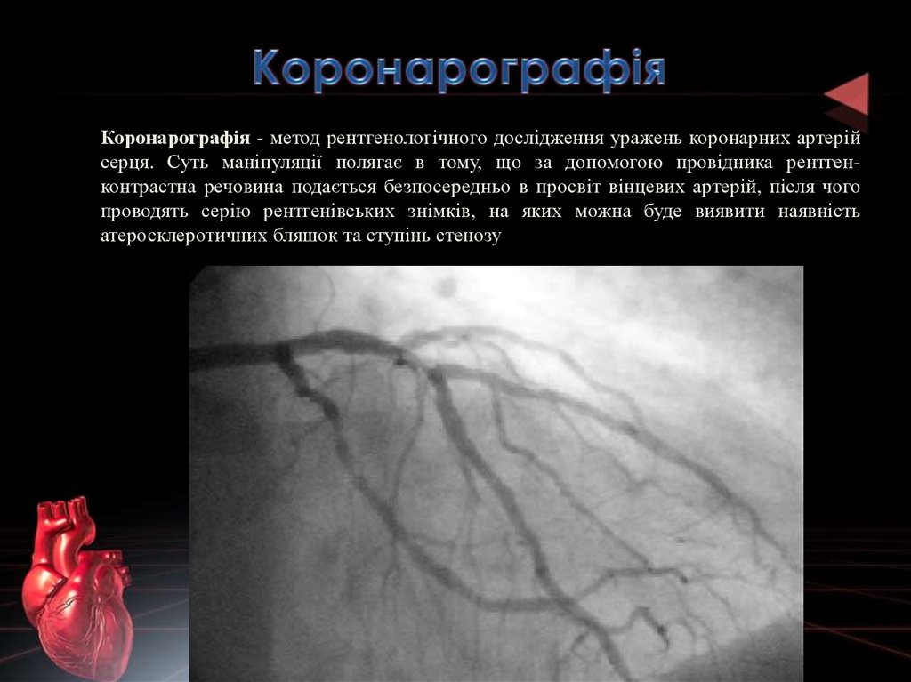 Реферат: Особливості перебігу ішемічної хвороби серця у хворих після стентування коронарних артерій