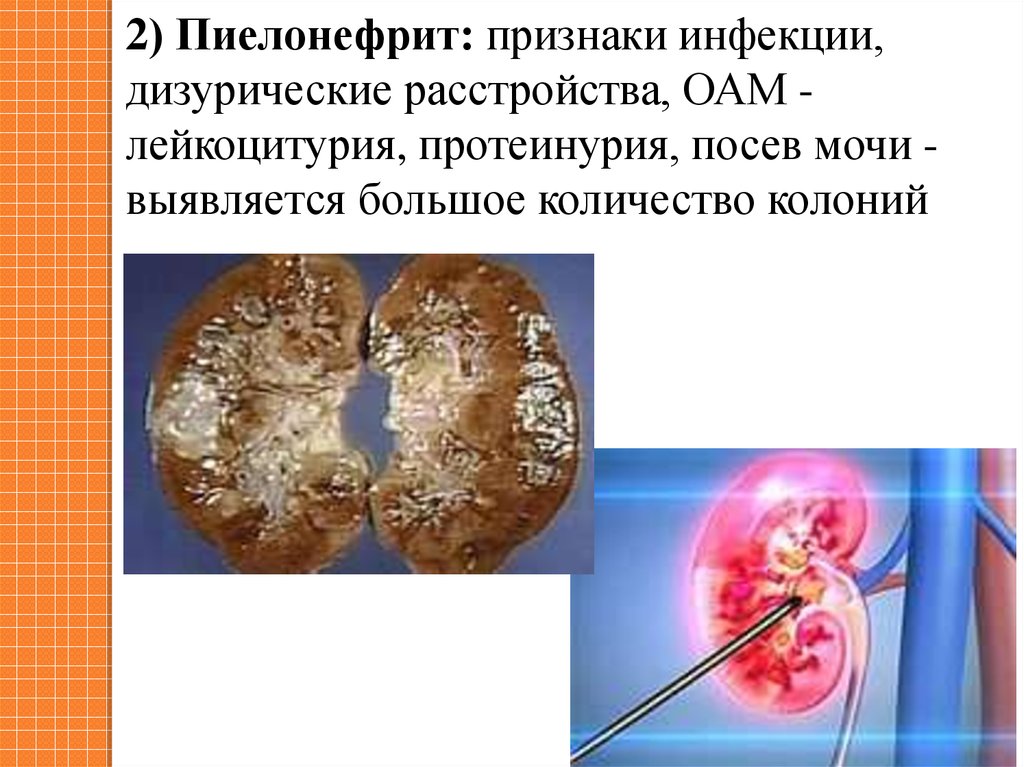 Болезнь г б. Почечная инфекция симптомы. Пиелонефрит протеинурия. Пиелонефрит лейкоцитурия. Протеинурия лейкоцитурия.