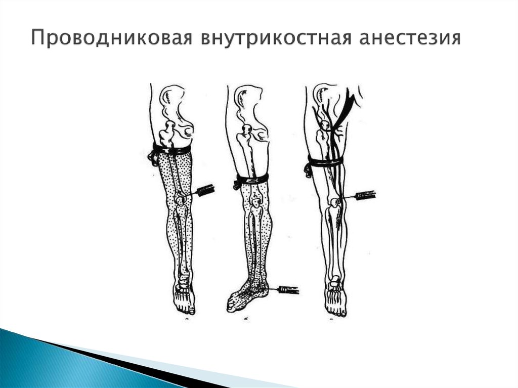 Блокада предплечья. Футлярная блокада конечностей. Футлярная анестезия конечности. Регионарной внутрикостной анестезии. Проводниковая внутрикостная анестезия это.