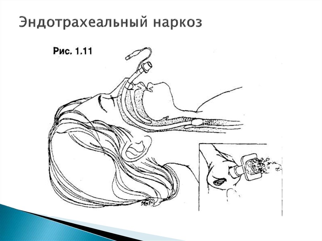 Схема эндотрахеального наркоза