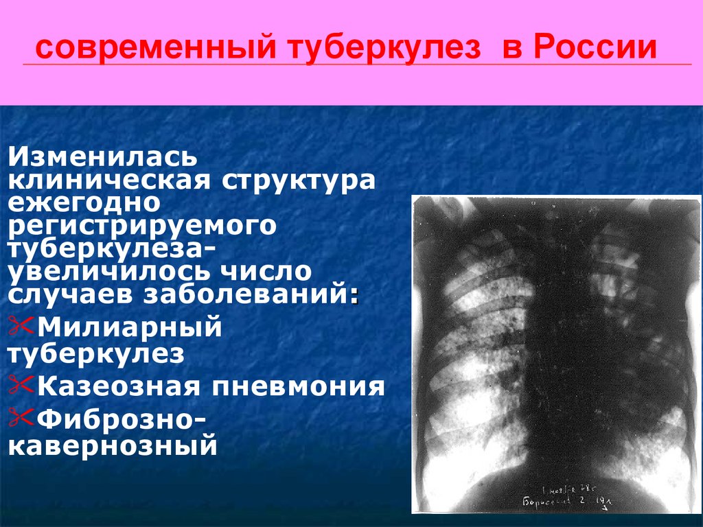 современный туберкулез в России