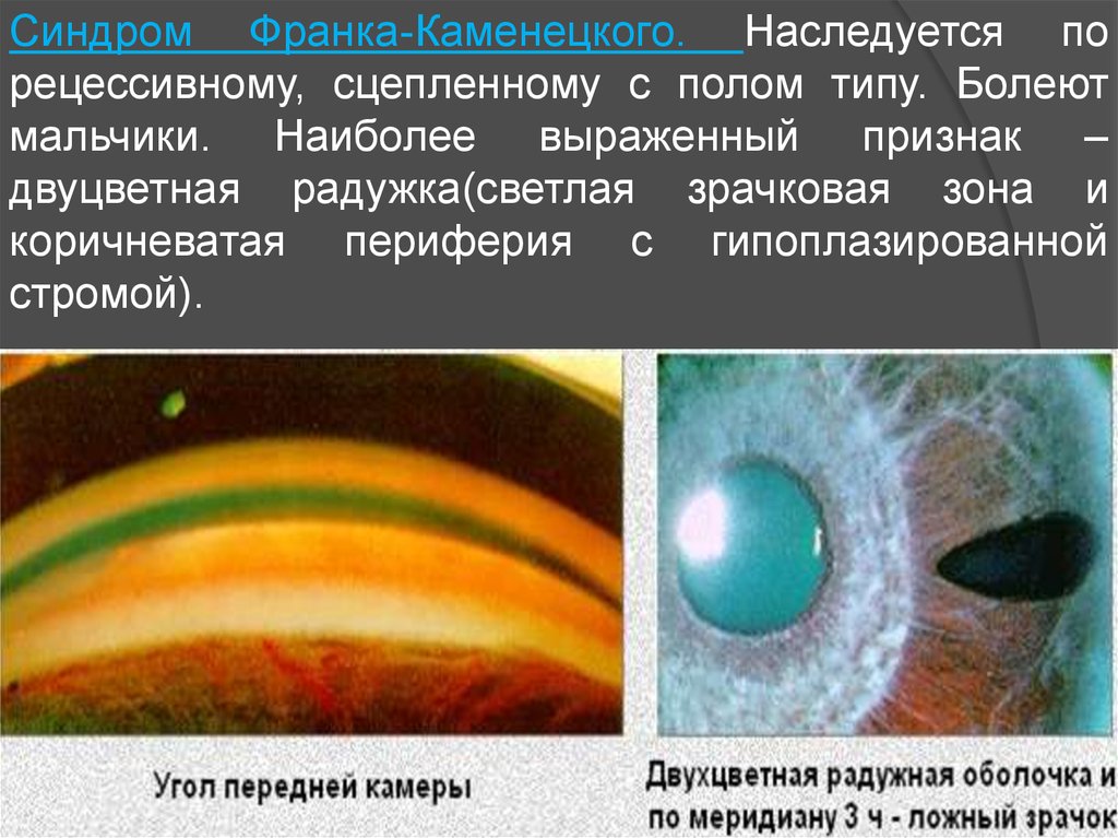 Глаукома презентация офтальмологии