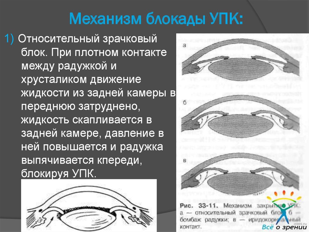 Закрытоугольная глаукома клинические рекомендации. Относительный зрачковый блок. Первичная закрытоугольная глаукома со зрачковым блоком. Функциональный зрачковый блок. Механизм зрачкового блока.