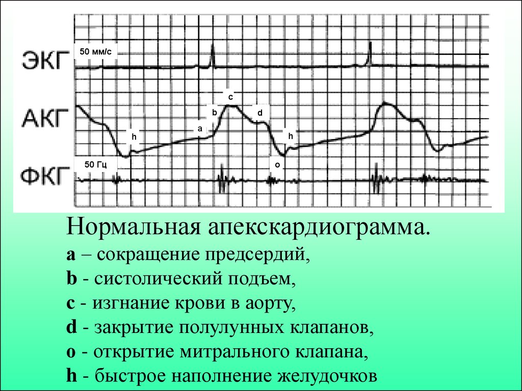 Нормальная апекскардиограмма. а – сокращение предсердий, b - cистолический подъем, с - изгнание крови в аорту, d - закрытие полулунных клапано
