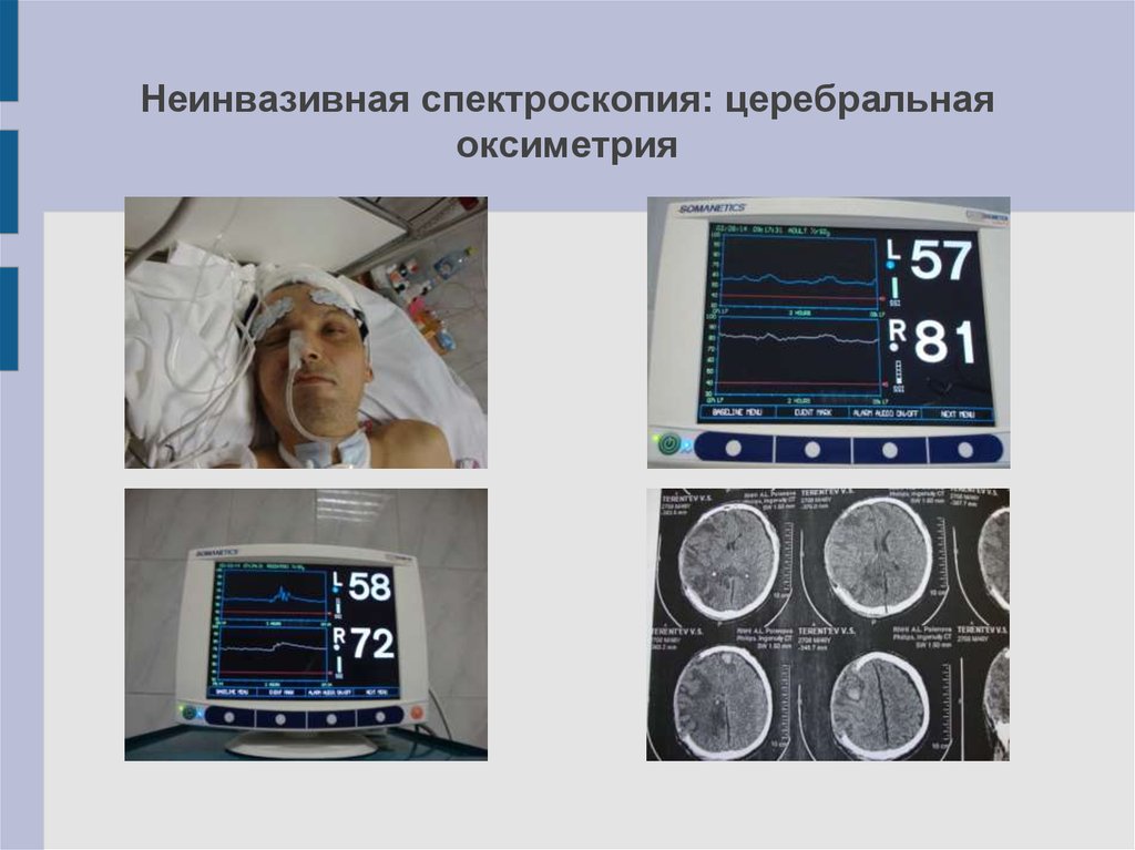 Неинвазивная спектроскопия: церебральная оксиметрия