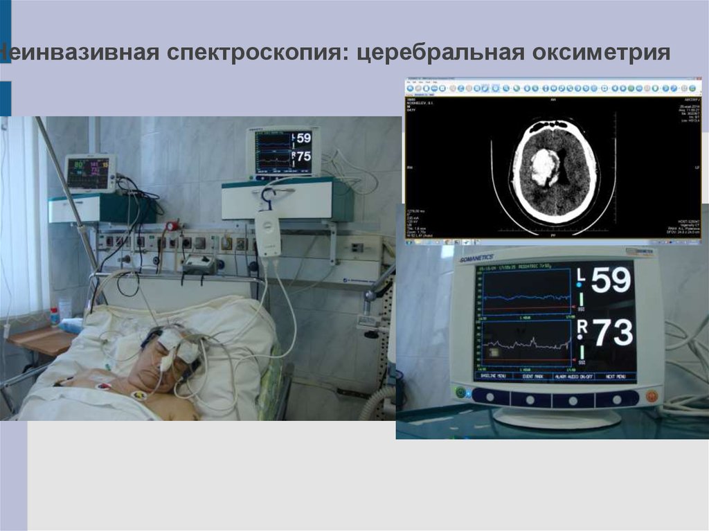 Неинвазивная спектроскопия: церебральная оксиметрия