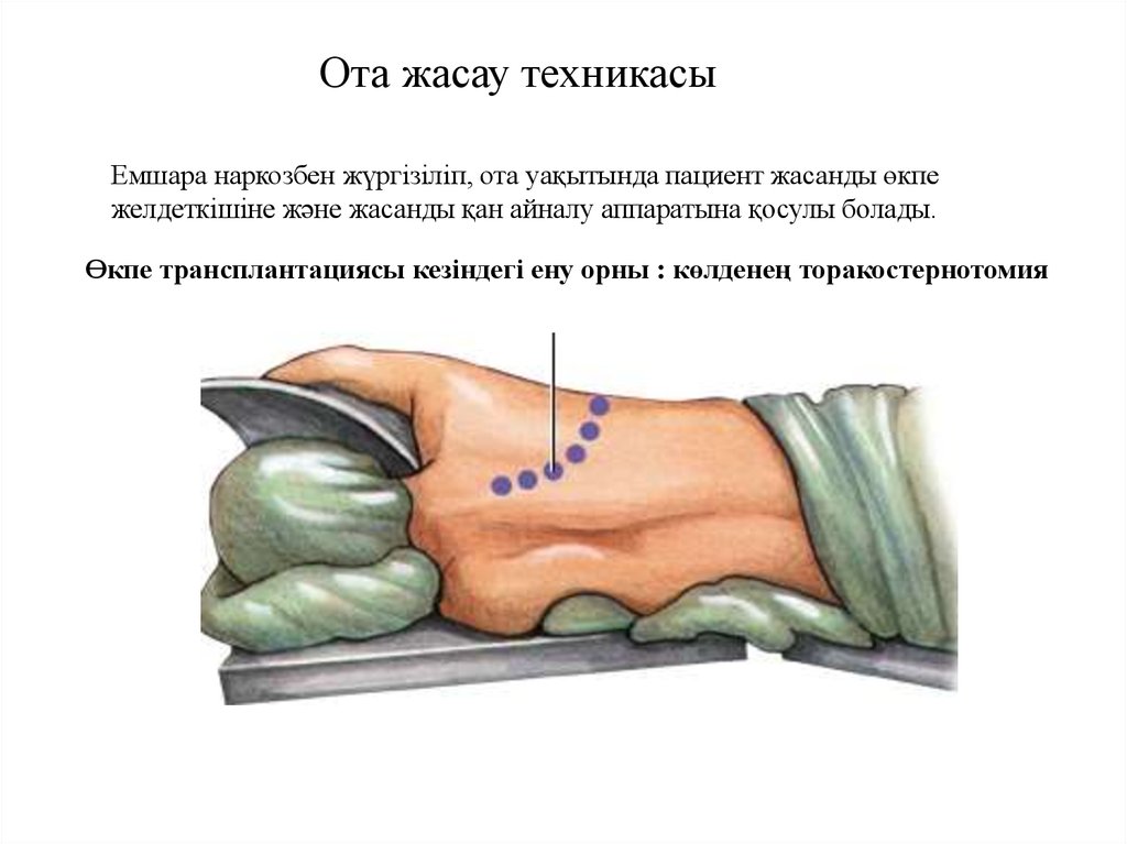 Трансплантация легких презентация