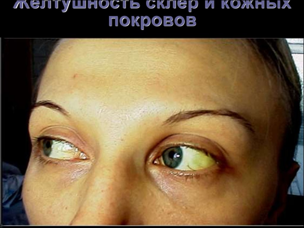 Почему глаза желтоватого. Пожелтение склер гепатит. Желтушность склер при гепатите.