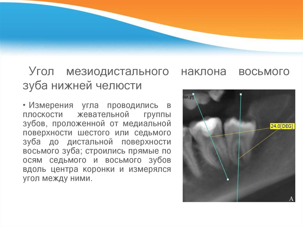 Угол мезиодистального наклона восьмого зуба нижней челюсти