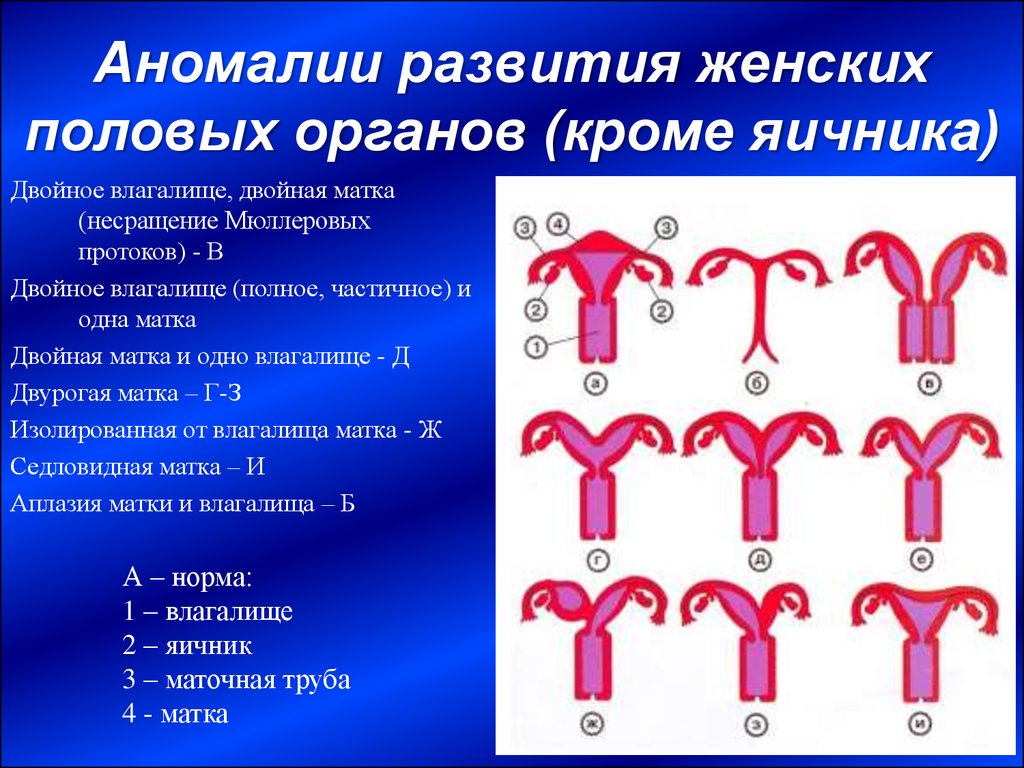 Аномалии развития женских половых органов (кроме яичника)