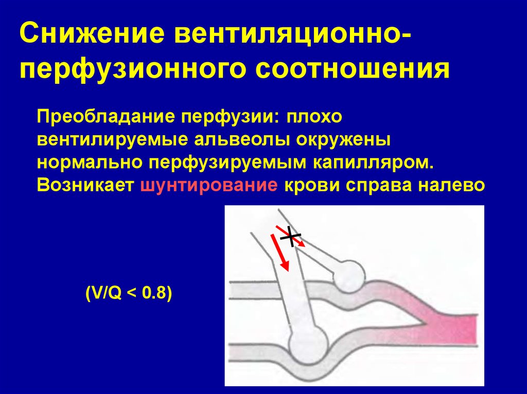 Соотношение вентиляции и перфузии. Альвеолярный веноартериальный шунт. Альвеолярное веноартериальное шунтирование.. Альвеолярное шунтирование крови. Легочный шунт.