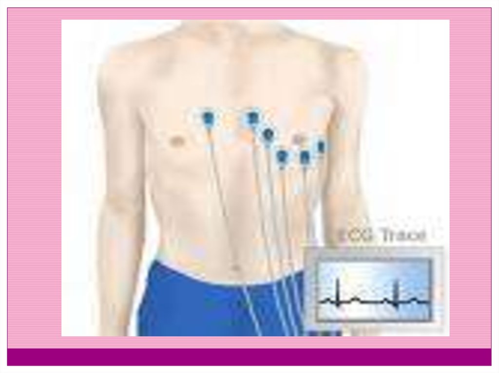 Экг где. Валента схема наложения электродов. Грудные электроды для ЭКГ. Прикрепление электродов ЭКГ. ЭКГ как накладывать электроды.