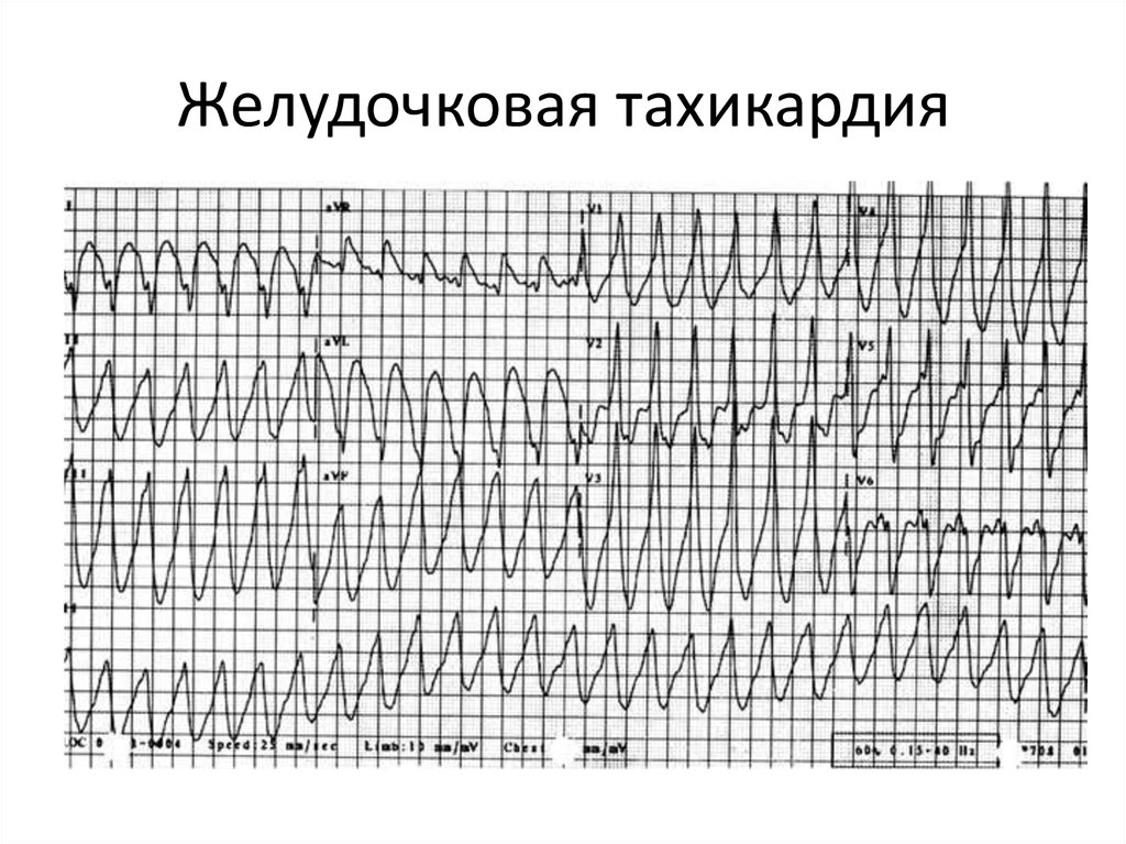 Фото желудочковая тахикардия