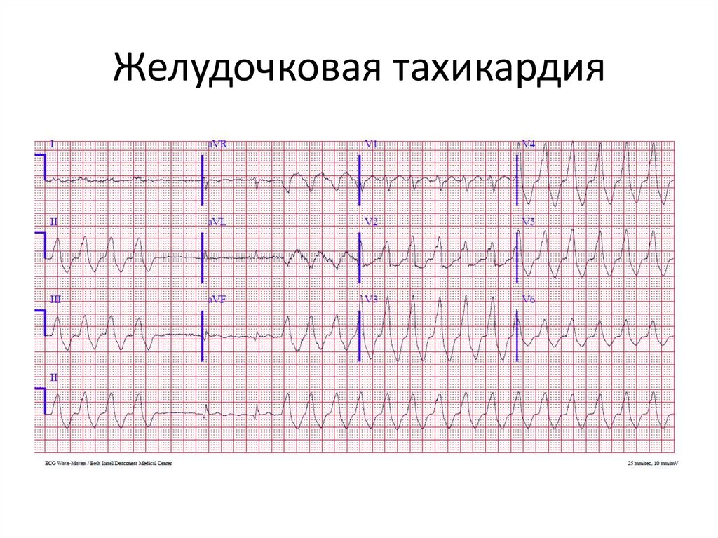 Фото желудочковая тахикардия