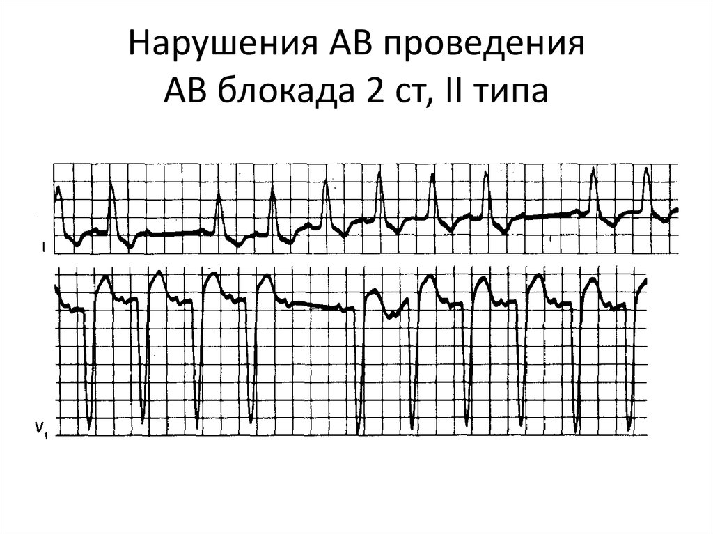 Полная блокада мкб. АВ блокада 2 ст. Av блокада 2 ст. АВ блокада осложнения. Травматический инфаркт миокарда.
