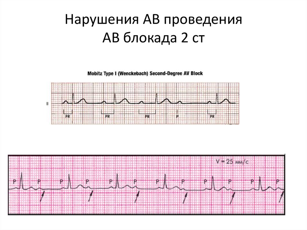 Ав блокада 1 степени у детей