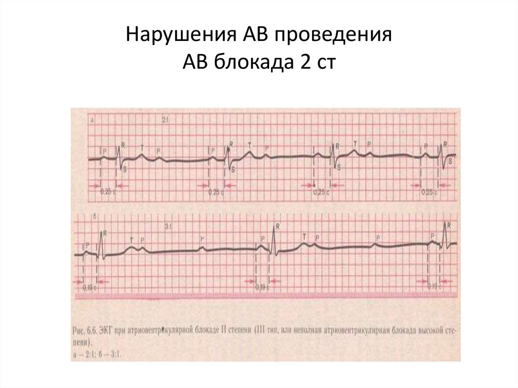 Ав блокада сердца 1 степени