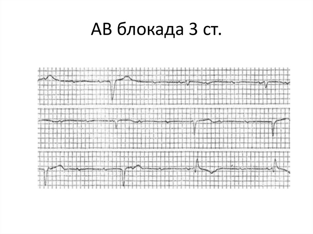 Ав блокада презентация