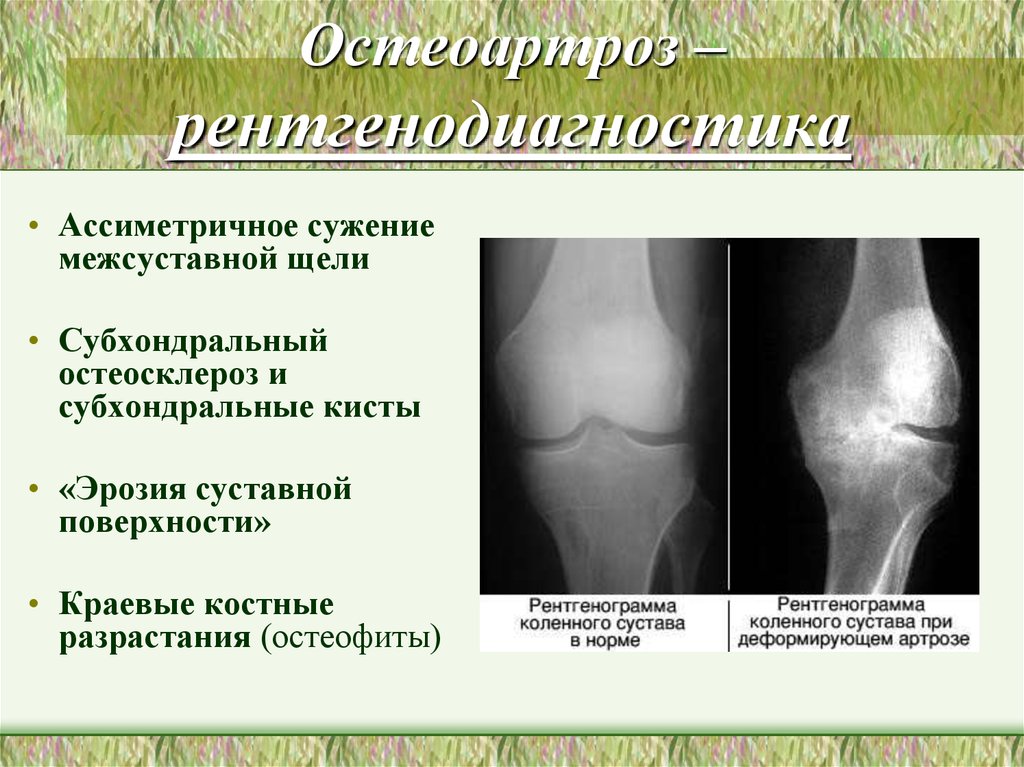 Деформирующий артроз презентация