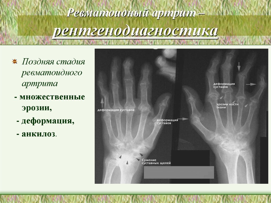 Ревматоидный артрит – рентгенодиагностика