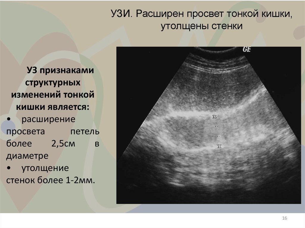 Узи стенок. Кишечная непроходимость на УЗИ.