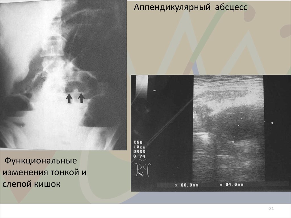 Аппендикулярный инфильтрат кт картина