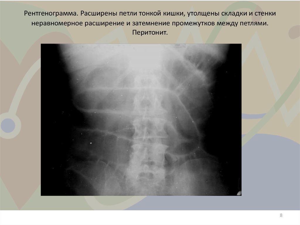 Стенки миометрия утолщены неравномерно