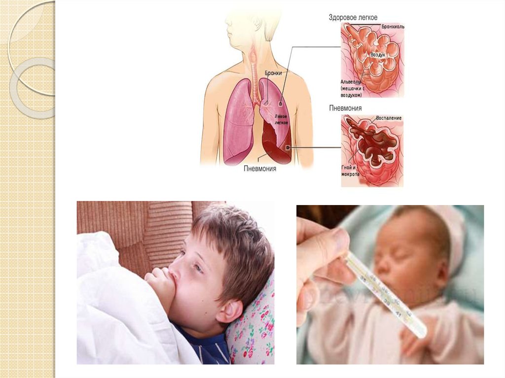 Воспаление легких у детей