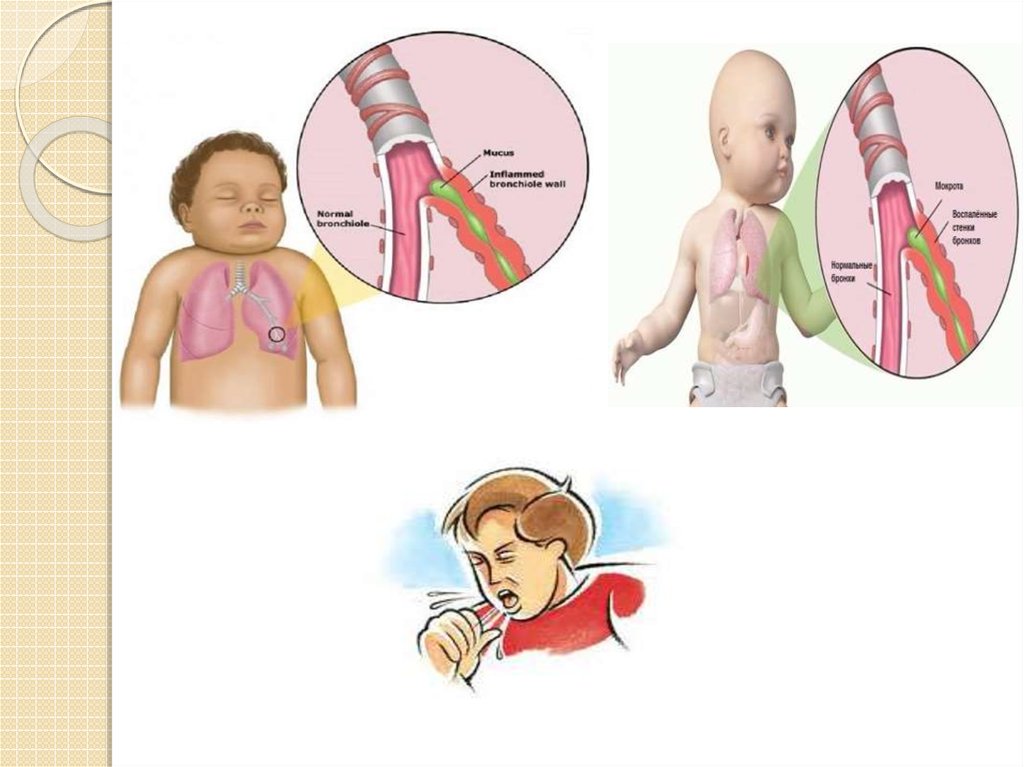 Пневмония у детей презентация