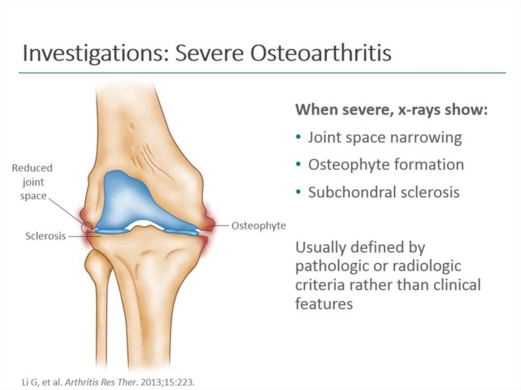 Investigations: Severe Osteoarthritis