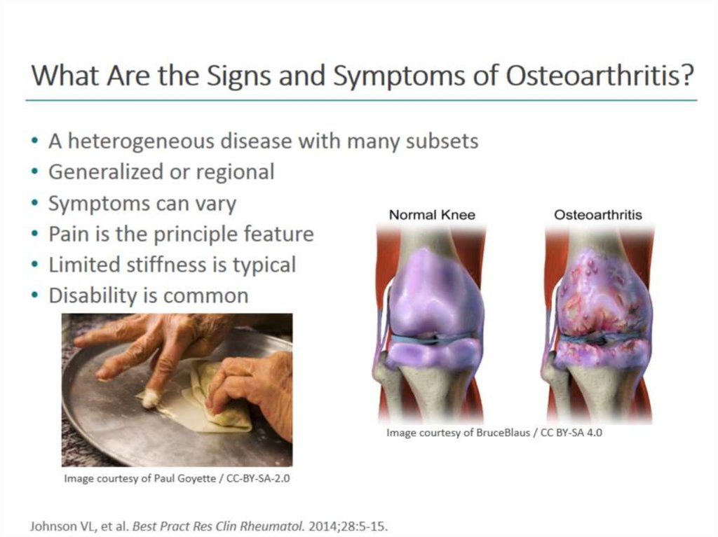 What Are the Signs and Symptoms of Osteoarthritis?