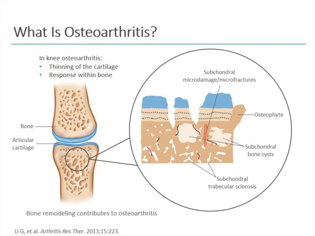 What Is Osteoarthritis?