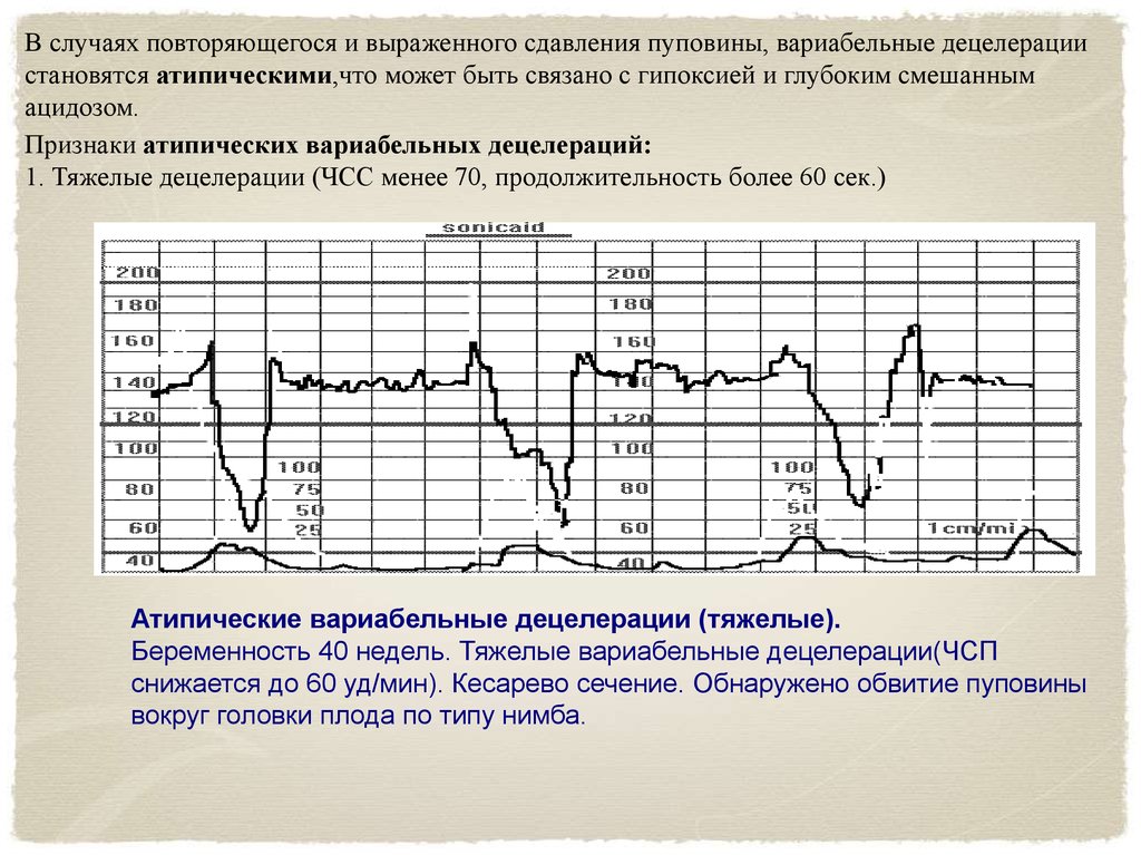 Чсс по неделям беременности. КТГ плода расшифровка акцелерации и децелерации. Патологическая кривая КТГ. Патологический Тип КТГ. Ранние децелерации на КТГ.