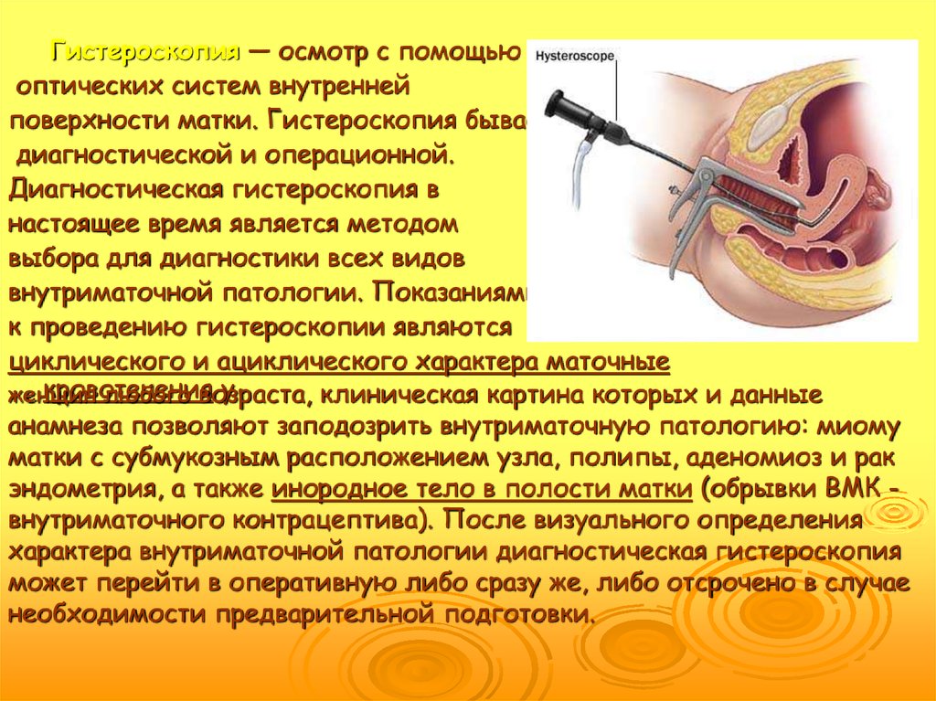 Гистероскопия эндометрия отзывы