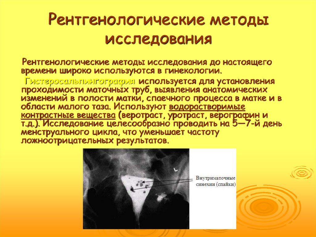 Негативное изображение во время проведения рентгенологического метода исследования образуется при