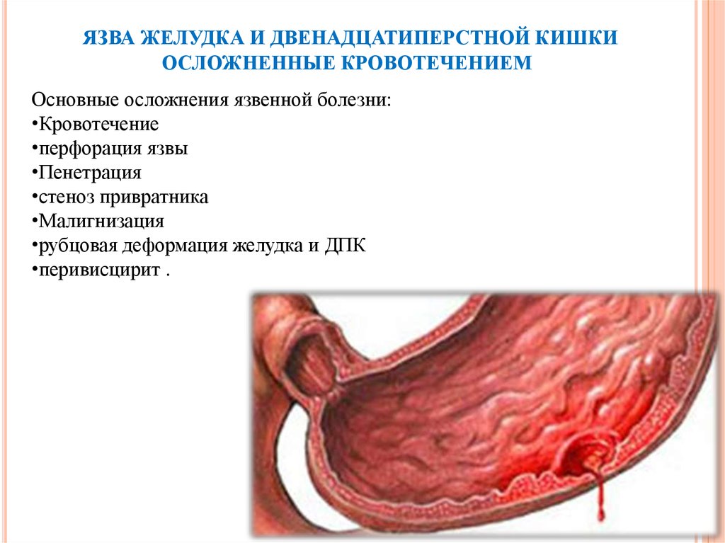 Язва желудка и двенадцатиперстной кишки презентация