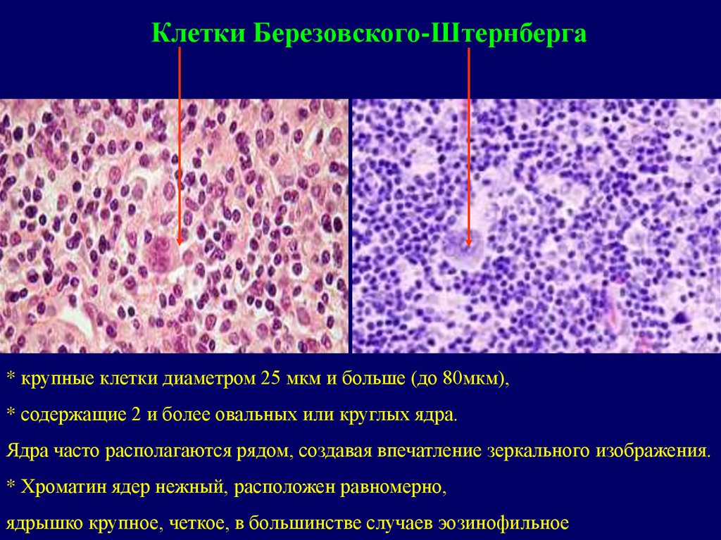 Диффузная в клеточная лимфома клинические рекомендации. Клетки Березовского Штернберга гистология. Диагностические клетки лимфомы Ходжкина. Клетка Березовского-Штернберга при лимфогранулематозе. Лимфома Ходжкина микропрепарат.