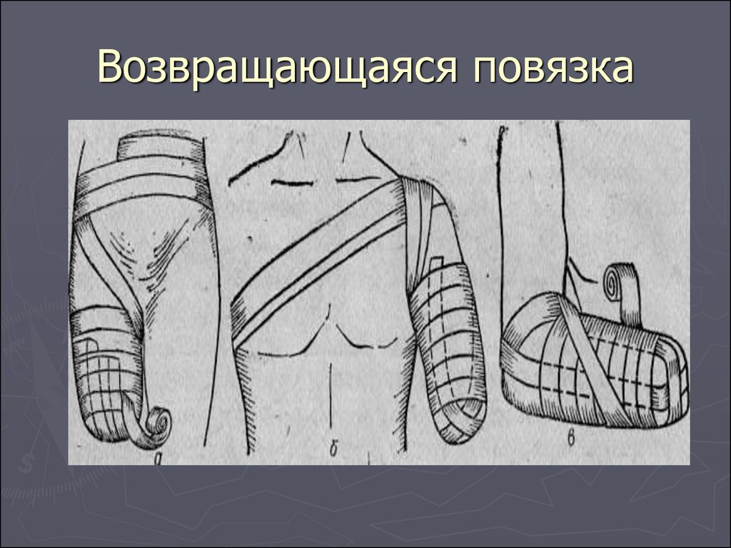 Повязка на культю. Возвращающаяся повязка на культю бедра. Возвращающаяся повязка на культю конечности после ампутации. Возвращающаяся бинтовая повязка. Возвращающаяся повязка повязка Дезо.